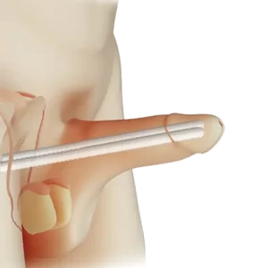 Penil protez örneği